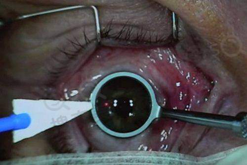 深圳卫尔斯眼科门诊部 本地人都说收费抄不贵且正规——技术与服务优势