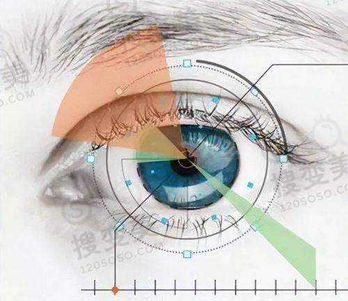 深圳卫尔斯眼科门诊部 本地人都说收费抄不贵且正规——近视手术成效